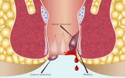 External Hemorrhoids Treatment