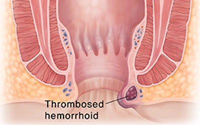 Thrombosed Hemorrhoids Treatment