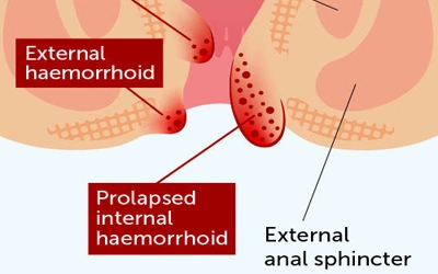 Prolapsed Hemorrhoids Treatment