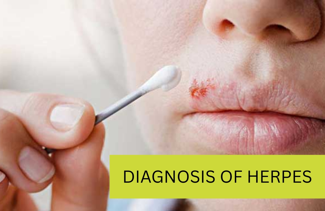 Diagnostic for Herpese