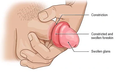 treatment for penis foreskin cannot be pulled forward
