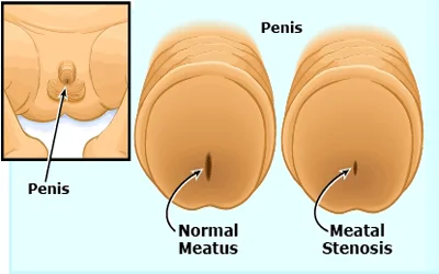 Difficulty urinating treatment