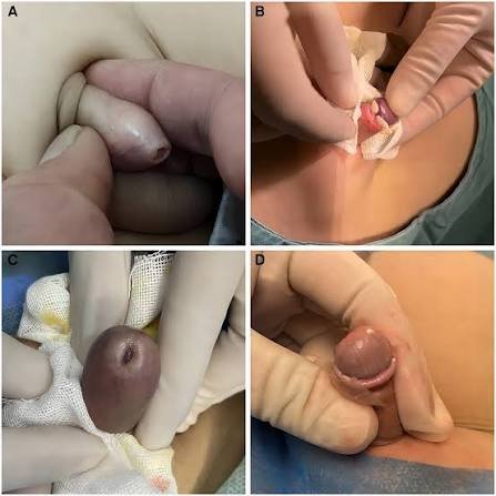 Clinical reference collage showing different foreskin and glans presentations that require medical assessment