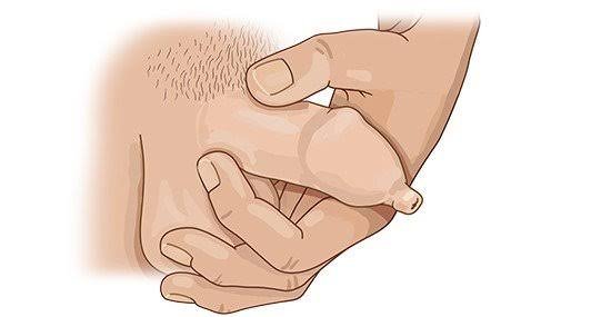 Clinical illustration showing how the foreskin may be gently examined when phimosis is suspected