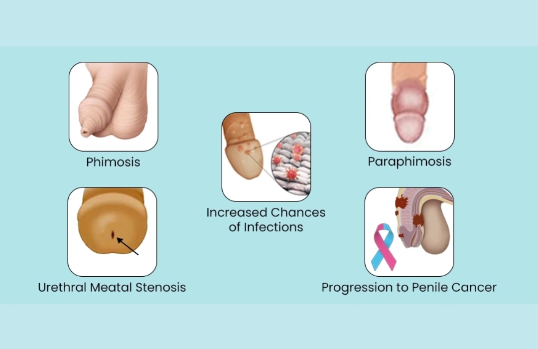 Educational illustration of conditions and complications associated with phimosis