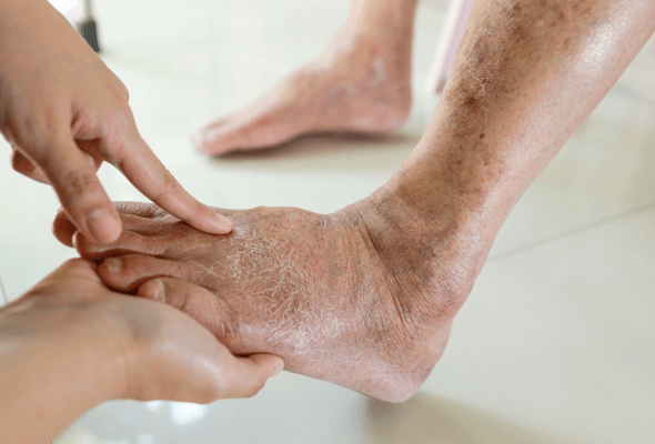 Diabetes foot care and prevention