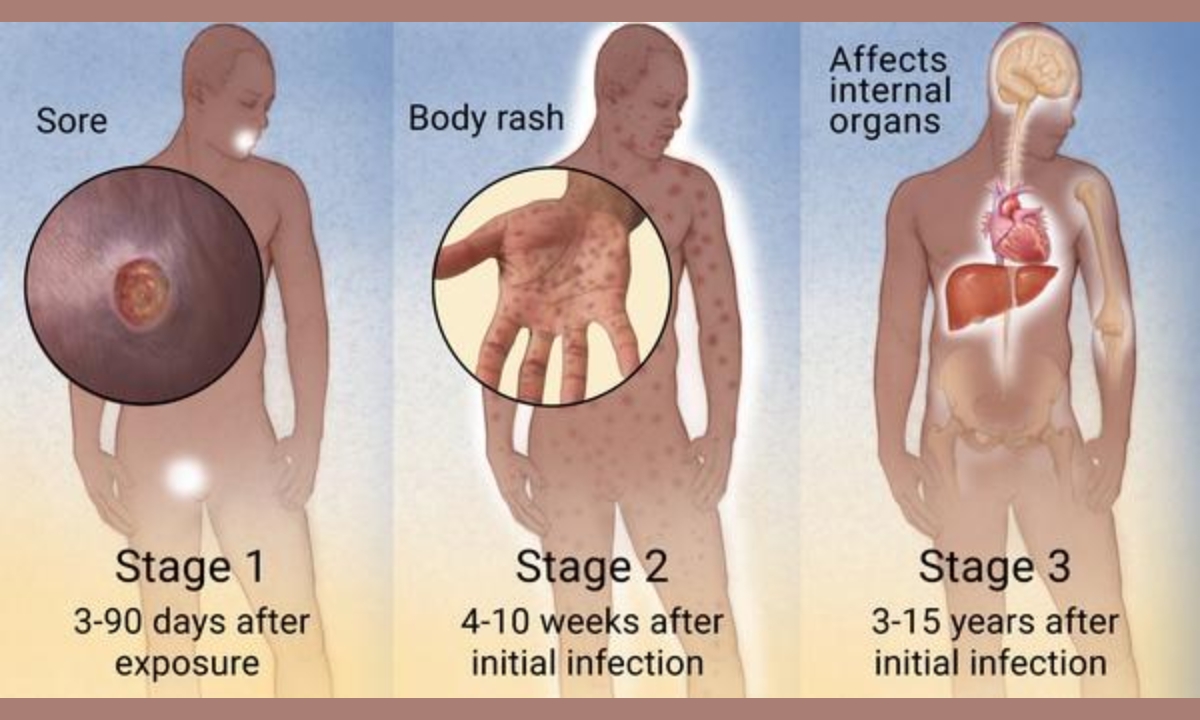 syphilis stages